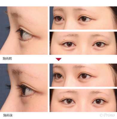 HM 蒙古襞形成術＋他院下眼瞼拡大修正術 症例経過写真