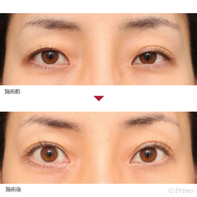 HN 二重埋没法6点固定+目頭切開 症例経過写真