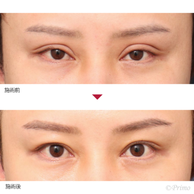 CZ 眼瞼下垂手術＋二重修正術 症例経過写真