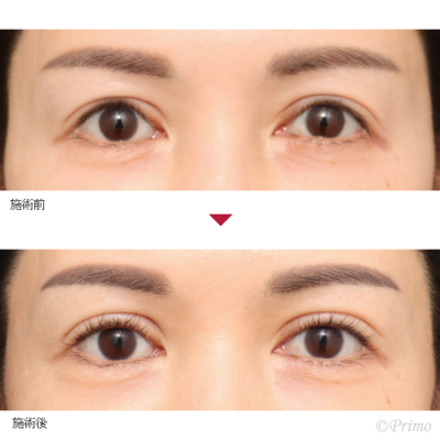 DA 眼瞼下垂修正術 症例経過写真