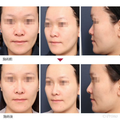 MN 鼻中隔延長術＋隆鼻術＋眉間プロテーゼ（特注）＋鼻翼基部プロテーゼ（特注）＋鼻尖形成術 症例経過写真