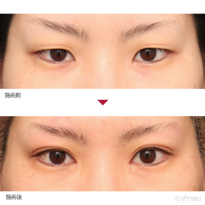 HO 二重埋没法６点固定＋上眼瞼脱脂術＋目頭切開 症例経過写真