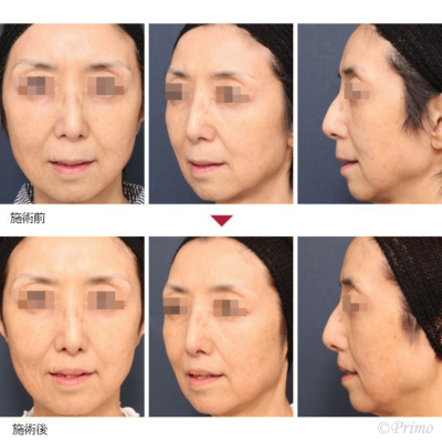 I 上口唇短縮術 症例経過写真