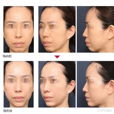 H アゴプロテーゼ 症例経過写真