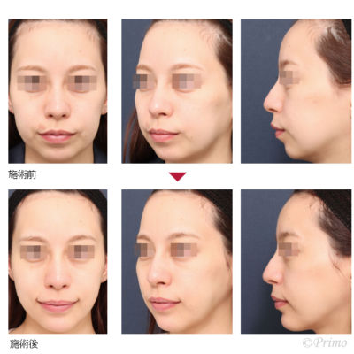 I アゴプロテーゼ＋コグリフト＋頬部脂肪吸引 症例経過写真