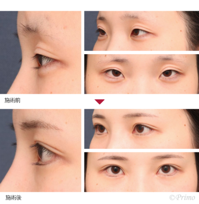 HJ 眼瞼下垂手術+目頭切開+下眼瞼拡大術+下眼瞼逆さまつ毛手術 症例経過写真