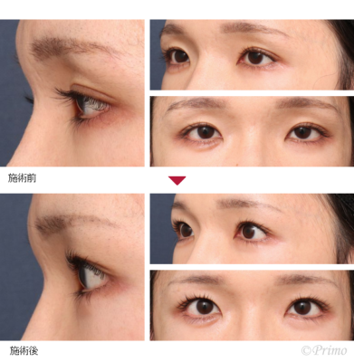 HP 眼瞼下垂手術＋下眼瞼拡大術＋目尻切開 症例経過写真