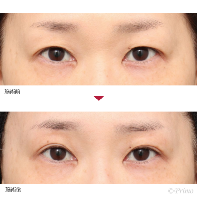 BD 上眼瞼リフト 症例経過写真