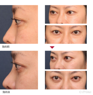 G 下眼瞼切開術(裏ハムラ法) 症例経過写真