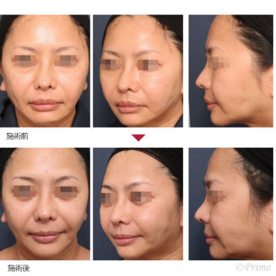 BB ミッドフェイスリフト 症例経過写真