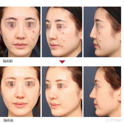 MP 鼻中隔延長術＋鼻背部軟骨移植術＋鼻尖形成術＋他院鼻プロテーゼ抜去術 症例経過写真