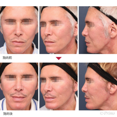 J 他院アゴプロテーゼ入れ替え術 症例経過写真