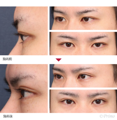 HT 眼瞼下垂手術＋下眼瞼拡大術＋目尻切開＋涙袋ヒアルロン酸注入 症例経過写真