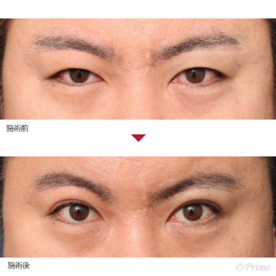 EE 全切開＋上眼瞼脱脂術＋ROOF切除術 症例経過写真