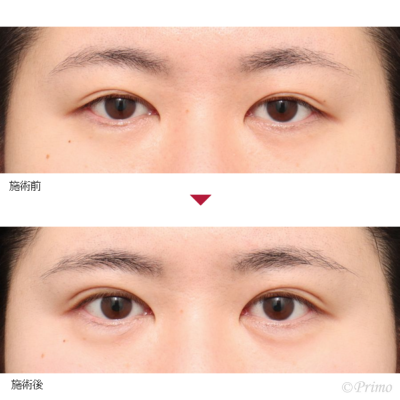 EF 全切開＋上眼瞼脱脂術＋ROOF切除術 症例経過写真