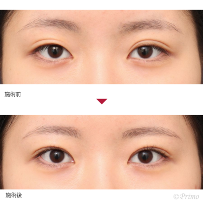 CK 眼瞼下垂手術＋二重修正術 症例経過写真