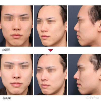 MX 鼻中隔延長術+鼻尖形成術+鼻背部軟骨移植術+鼻尖縮小術+鼻翼挙上術 症例経過写真