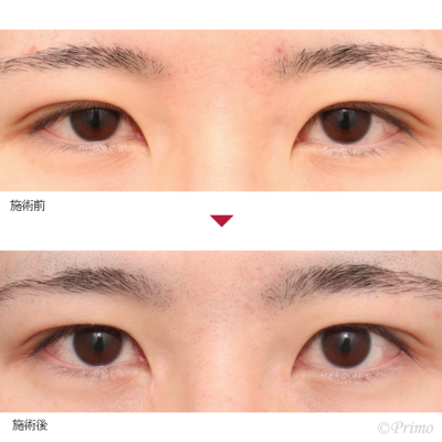 BV 目頭切開 症例経過写真