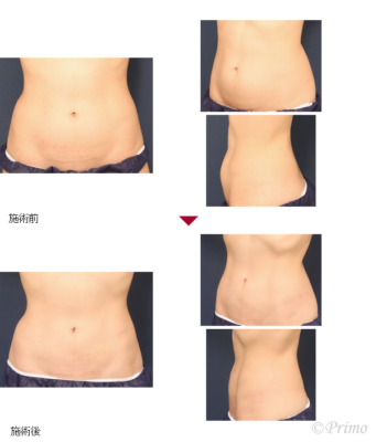 BQ 下腹部脂肪吸引 症例経過写真