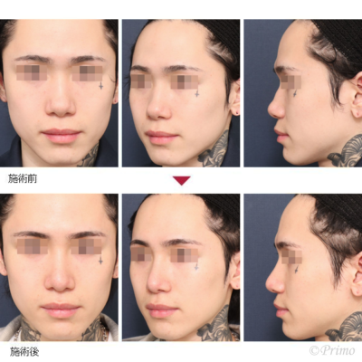 ND 鼻中隔延長術+隆鼻術+眉間プロテーゼ(特別注文プロテーゼ)鼻尖形成術+鼻尖縮小術 症例経過写真