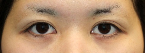 20170216術前目元