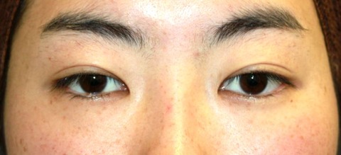 20160907術前目もと