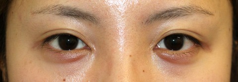 20160810術前目元