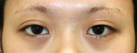 20170107術前目元