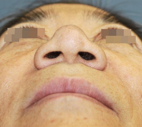 20161013術前あおり