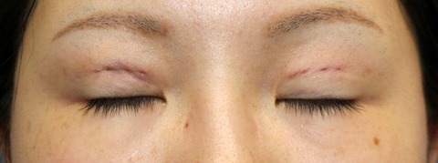 20160813pod1目元閉瞼