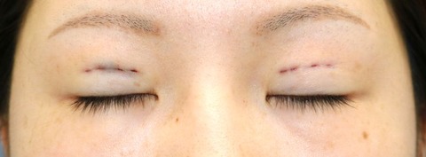 術後目元閉瞼20160808