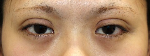 20170107術後目元