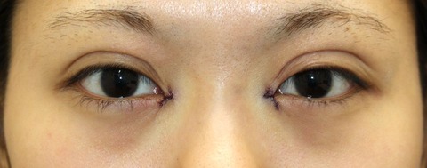 20170216術後目元