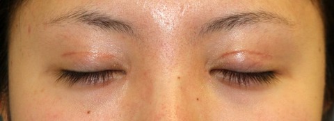 20160922po1M目元閉瞼