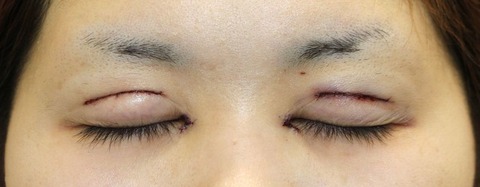 20170216術後目元閉眼