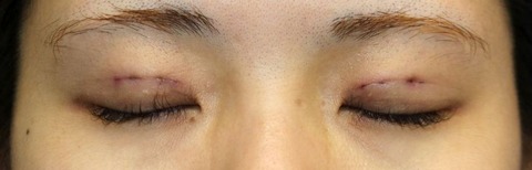 20161121po1d目元閉瞼