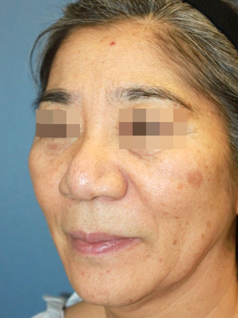 20161013術前斜め