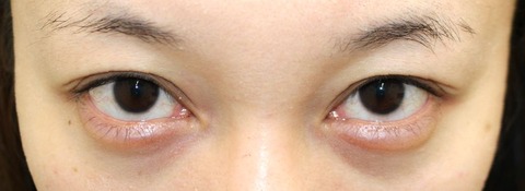 20170529po2W目元あおり