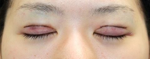 20170302術後目元閉眼
