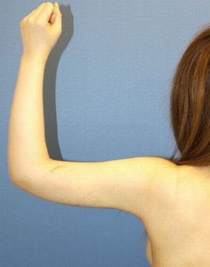 20160908po2W左腕後面