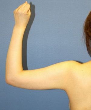 20160908術前左腕後面