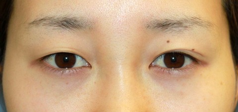 20160929術前目もと