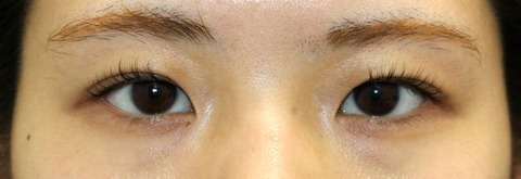 20161121術前目元