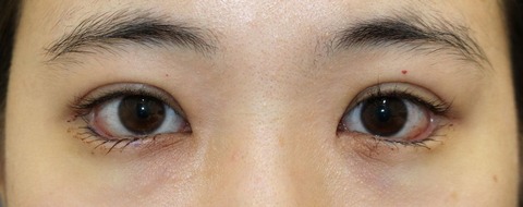 20160302術後目元