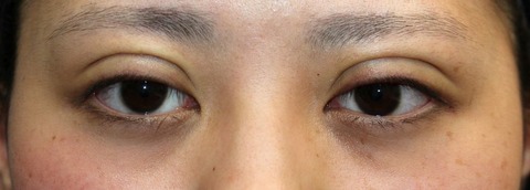 20170112術後目元