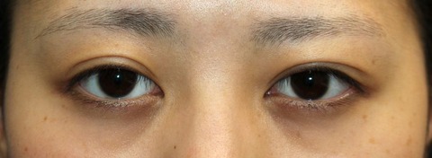 20170112術前目元