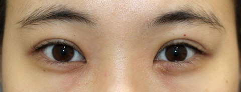 20160302術前目元