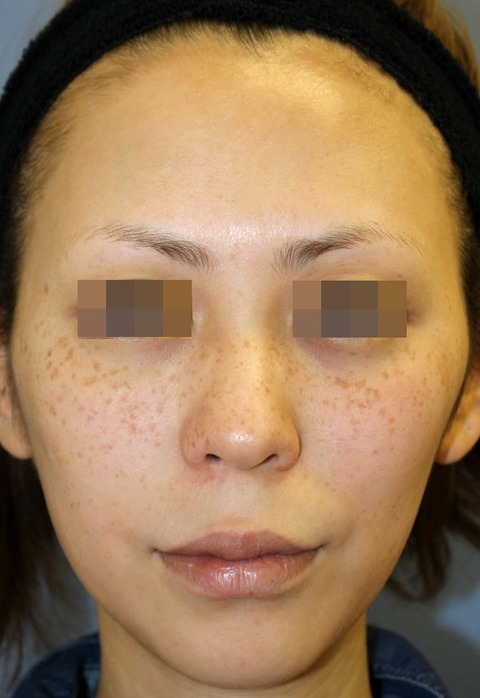 20161128施術前正面