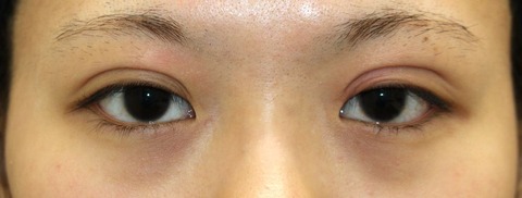 20170216術前目元