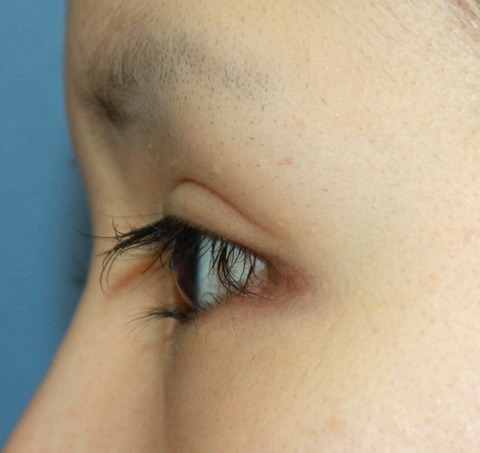 20160902術前左横